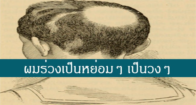 การรักษาผมร่วงผมบาง สาเหตุ ความจริงที่ต้องรู้ก่อนเริ่มรักษาอาการผมร่วง