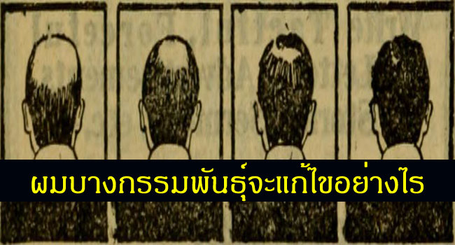 การรักษาผมร่วงผมบาง สาเหตุ ความจริงที่ต้องรู้ก่อนเริ่มรักษาอาการผมร่วง